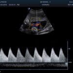 0 1 Umbilical Cord in PW Mode