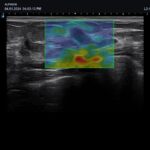 Breast Strain Elastography