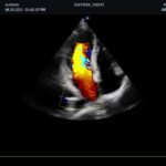 Copia de Cardiac 4 Chamber view in CF mode