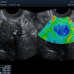 Elastography