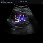 Renal Brilliant flow