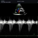 Tricuspid Valve Regusitation