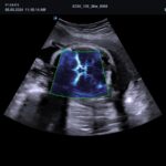 fetal head MCA MVI