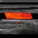 Copia de Carotid color