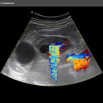 KidneyRenal Color mode Twinkle artifact Single