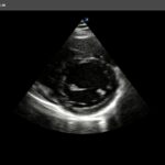 Parasternal Short Axis ViewPSAV 2D Papillary level Normal case Single