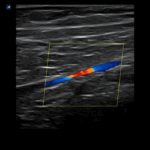 Peripheral artery in 2D web