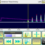 BASIC Doppler pressure